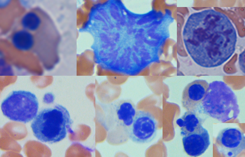 Bone marrow aspirate: dysplastic erythroid precursors